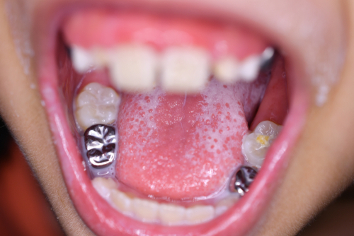 Can A Chipped Tooth Be Fixed?