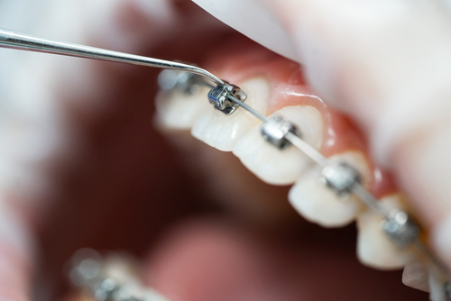 What is the Best Age to Have Teeth Braces?