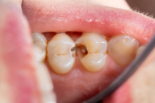 Should You Brush Your Teeth After Every Meal?