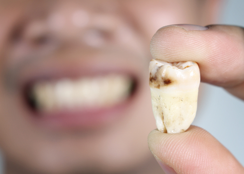What If I Ignore A Decay Tooth?