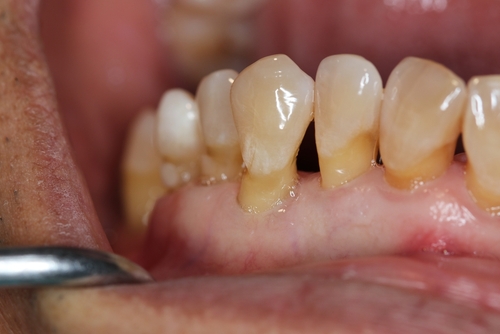 Dental gingivitis