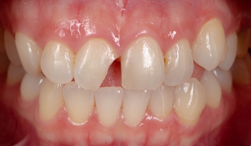 Coping with Tooth Chipping