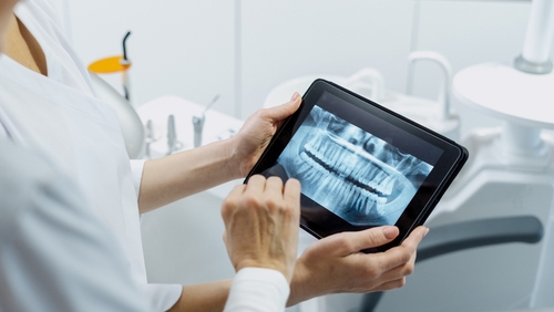 Diagnosing and Treating Tooth Chipping