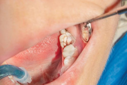 Risk Factors for Tooth Chipping