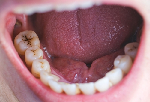 The Causes of Tooth Sensitivity