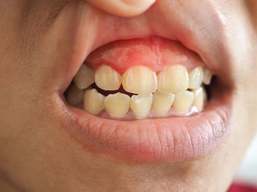Impact of Smoking on Gum Health