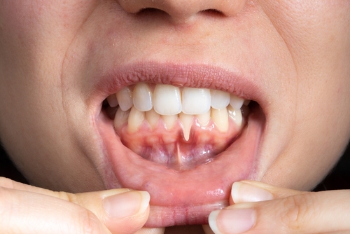 Gum Disease