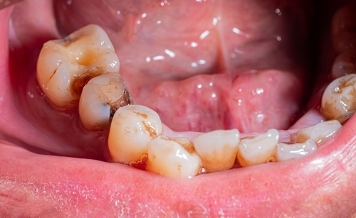 Tooth Decay