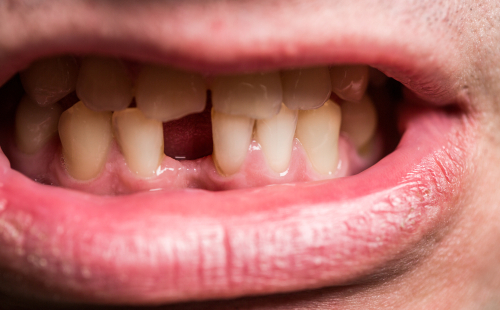 Tooth Erosion